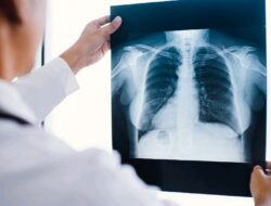 Kasus TB Ditemukan di Jawa Barat Ada 81 Ribu, STPI berupaya  Skrining Massal Menggunakan X-Ray